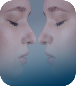 Non-Surgical Rhinoplasty
